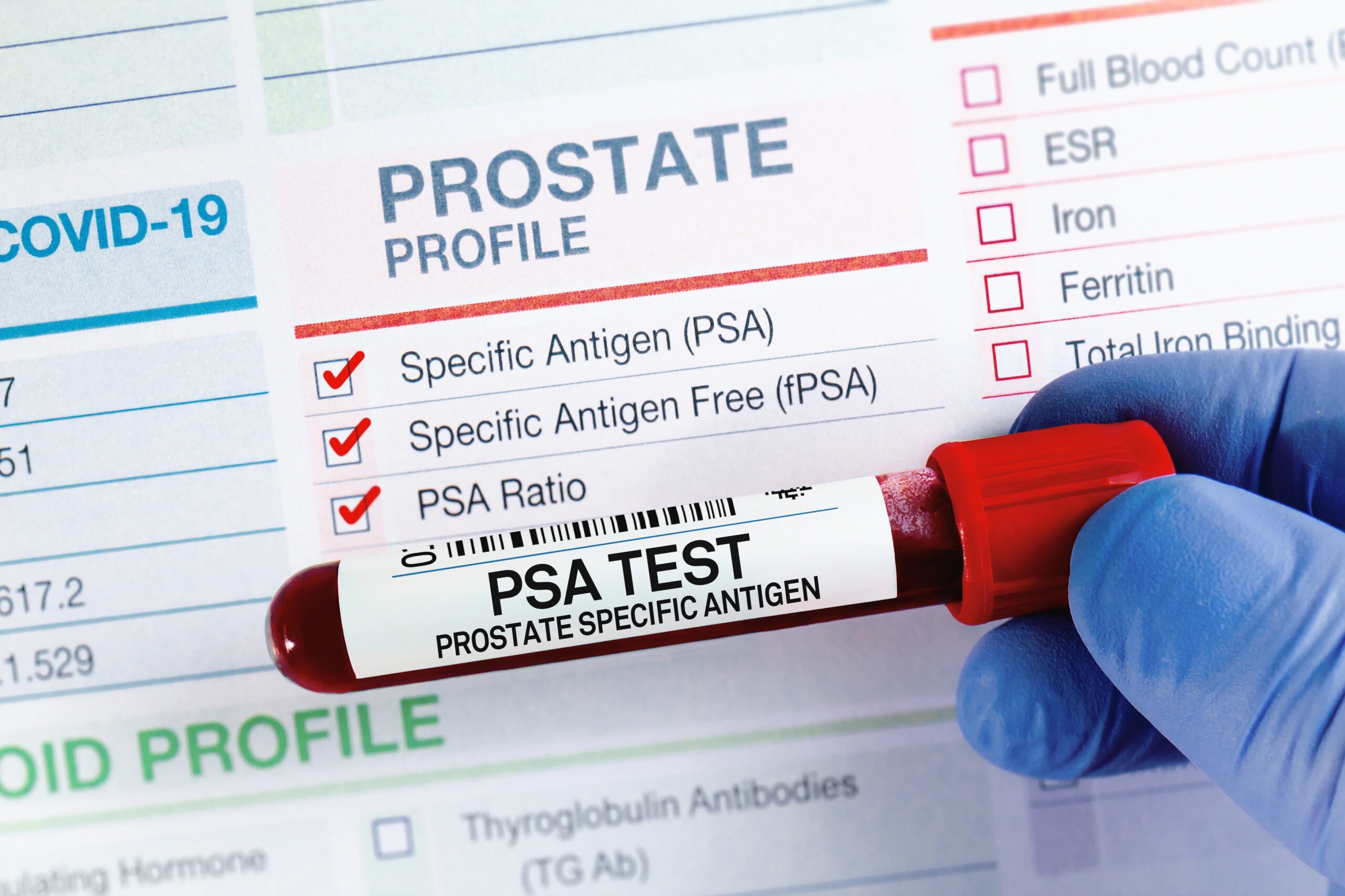 Is prostate blood test accurate